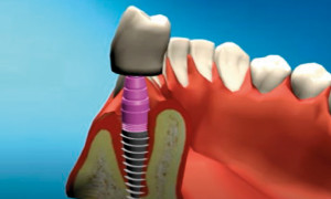 Tornillo para implantes dentales