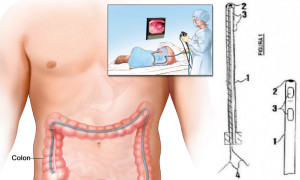 Sonda Gastrointestinal con Detector de Cambio de Temperatura