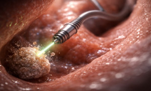 Microrobots magnéticos prometen eliminar las piedras renales sin necesidad de cirugía